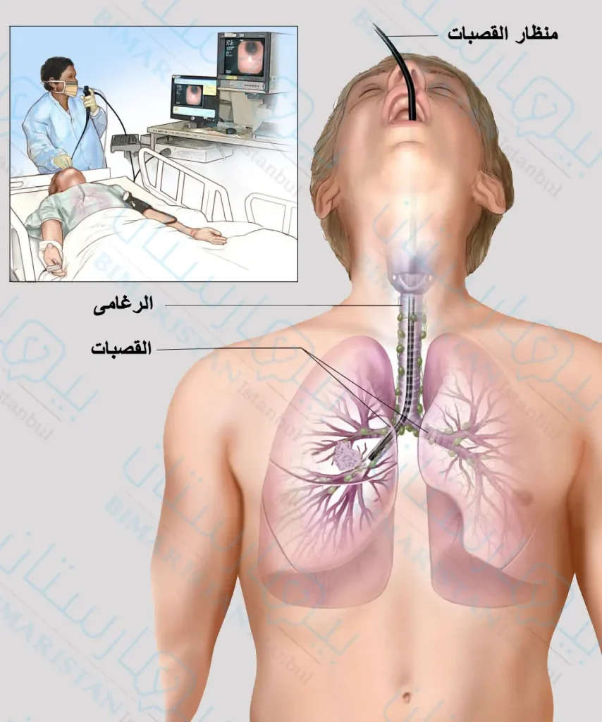 كيفية إجراء تنظير الشعب الهوائية والذي يتم عبر إدخال المنظار المخصص بالفم ومنه إلى الطرق الهوائية الأبعد