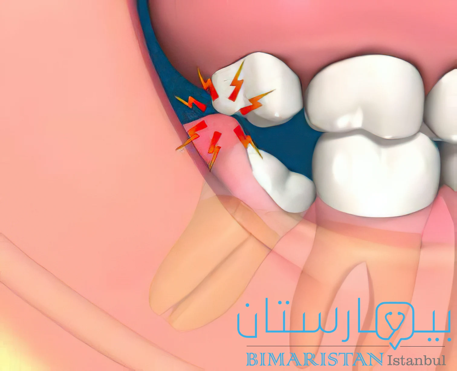 التهاب ماحول تاج السن نتيجة رض اللثة بسبب السن المقابل