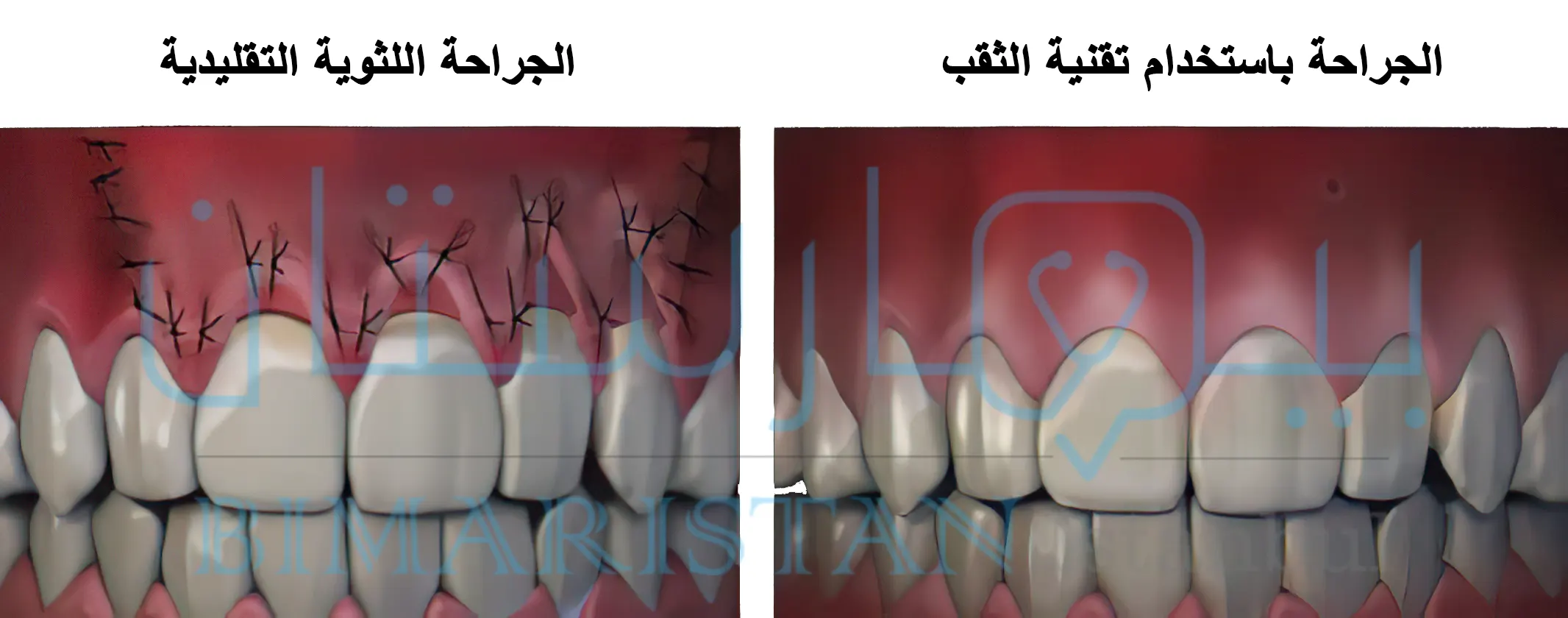 جراحة اللثة التقليدية وتقنية الثقب