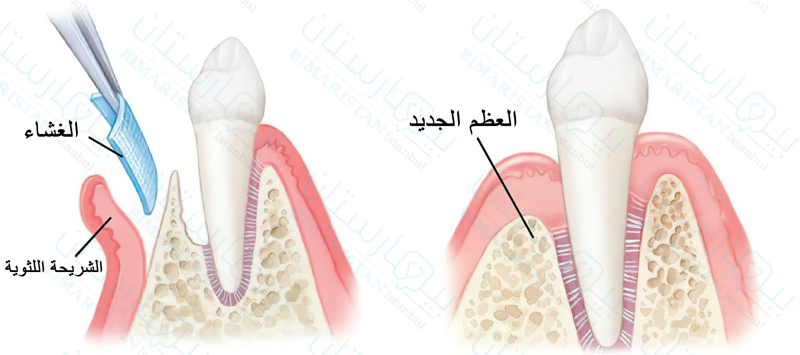 جراحة اللثة باستخدام تقنية تجديد الأنسجة الموجه Gtr