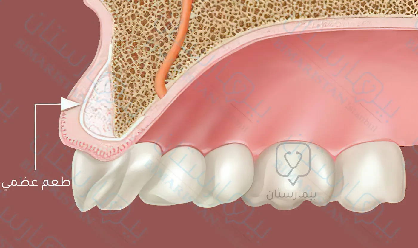 الطعم العظمي لعلاج انسحال اللثة