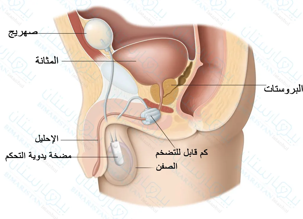 An Artificial Urinary Sphincter Closes The Urethra Via A Hand-Controlled Pump