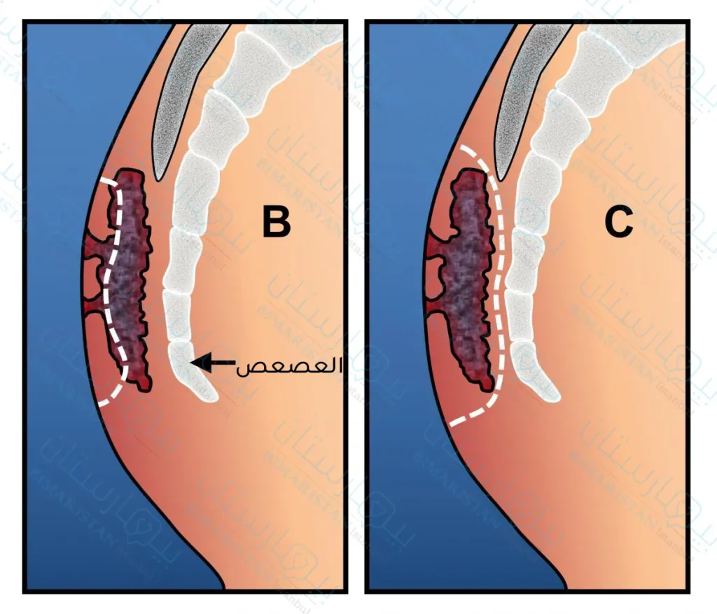 صورة تظهر أنواع عملية استئصال الناسور العصعصي