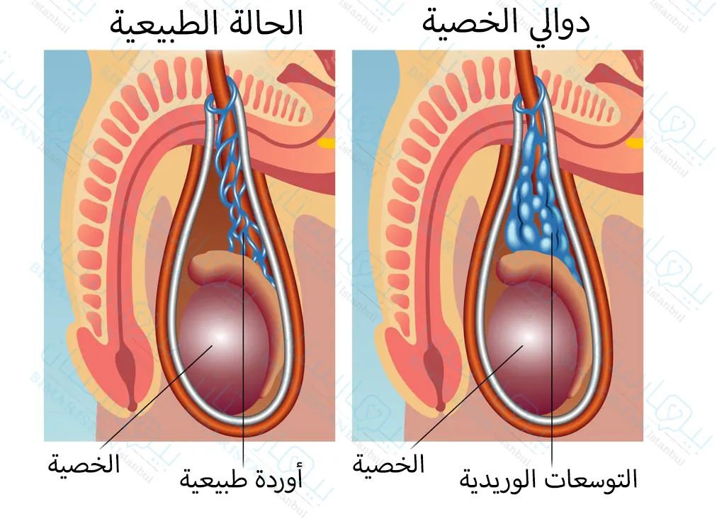 التوسعات الوريدية والتي تعرف باسم دوالي الخصية وهي من أسباب حدوث العقم عند الرجال، ولكي يتم علاج العقم عند الرجال يجب تدبير دوالي الخصية أولاً