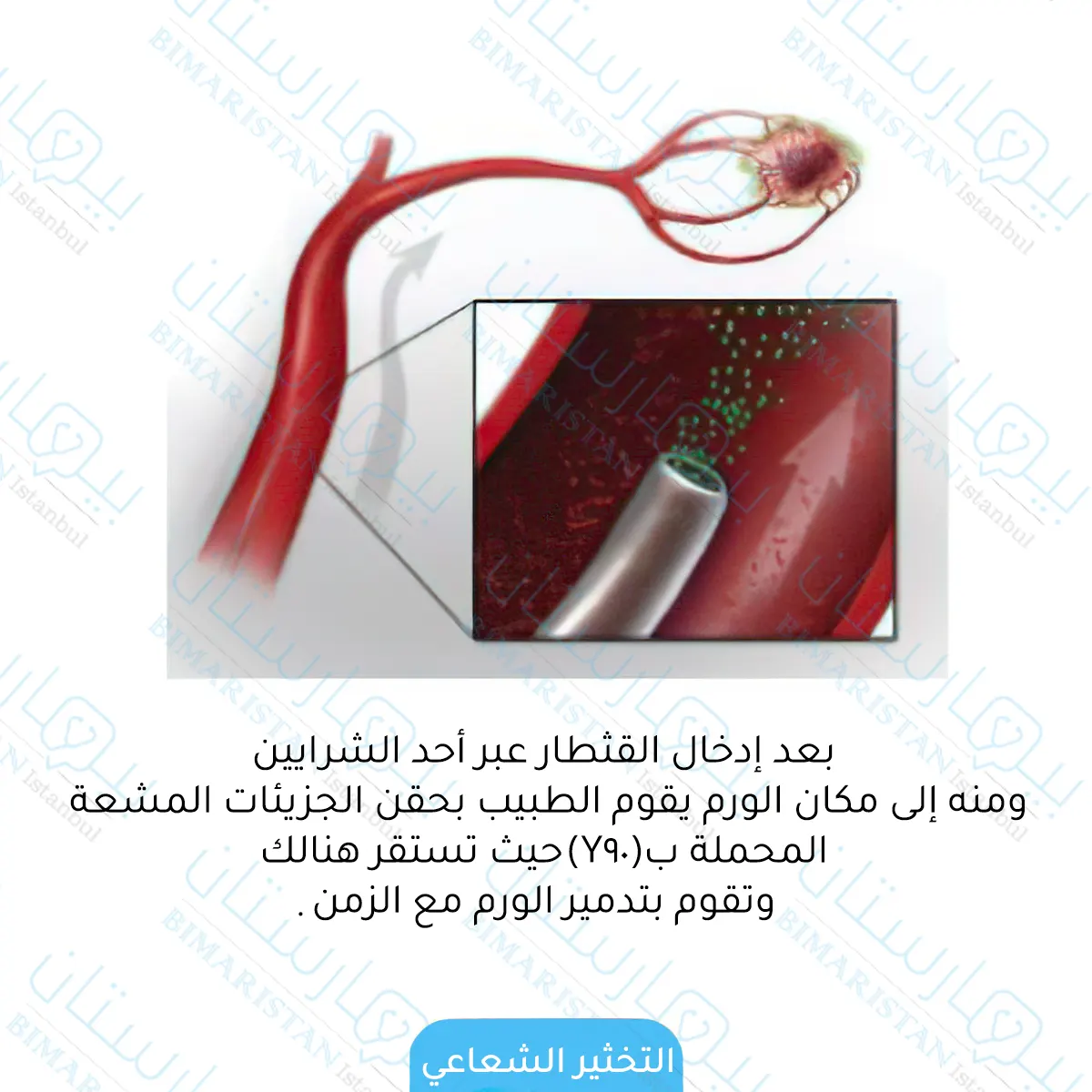 التخثير الشعاعي Radioembolization