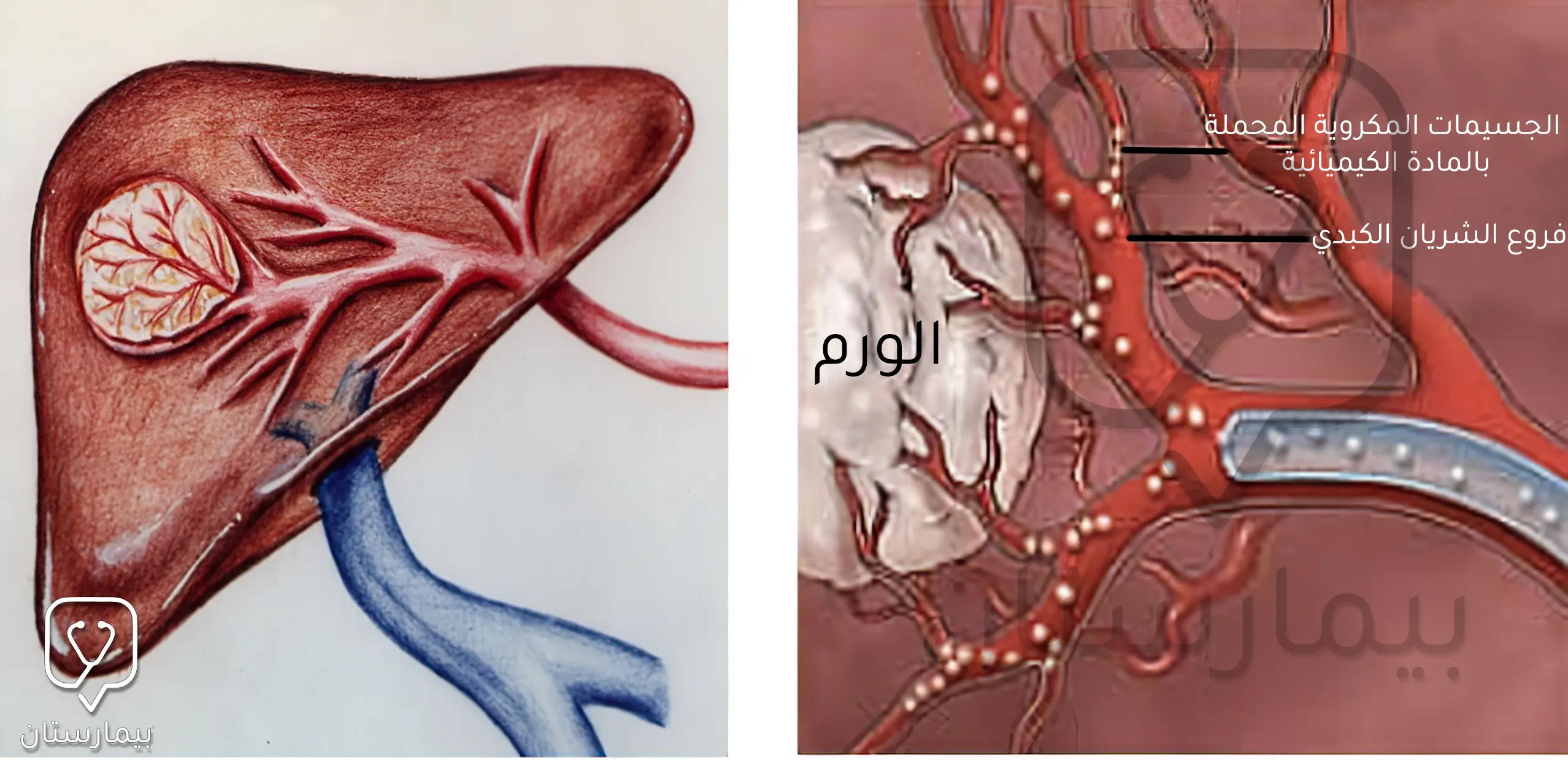 عملية التخثير الكيميائي Chemoembolization في تركيا وإدخال الجسيمات المكروية لسد الشرايين المغذية للورم الكبدي