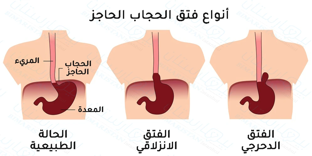 الأنواع الثلاثة لفتق الحجاب الحاجز وماذا يحدث في كل نوع من أنواع الفتق الحجابي