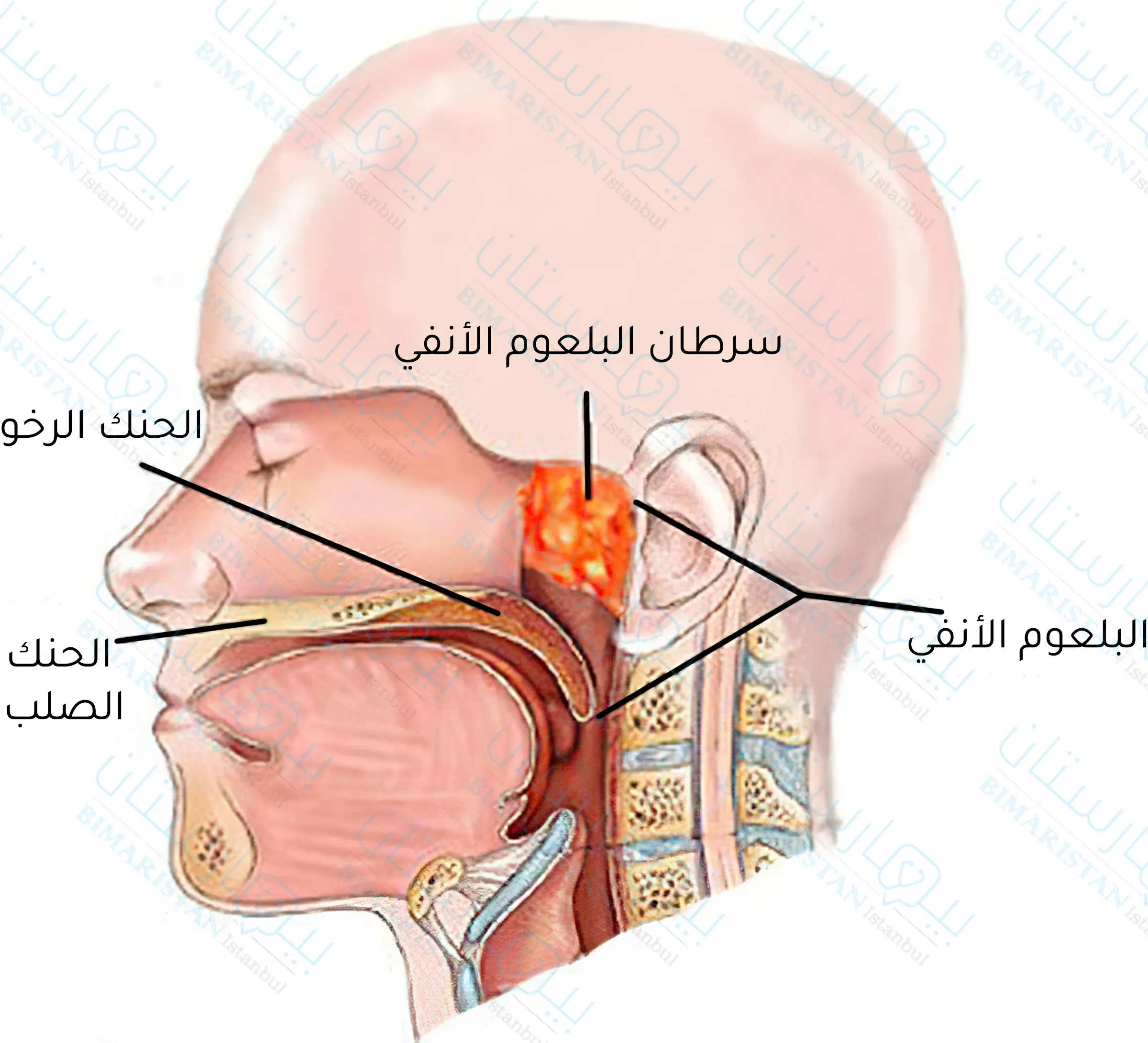 سرطان البلعوم الأنفي شائك الخلايا