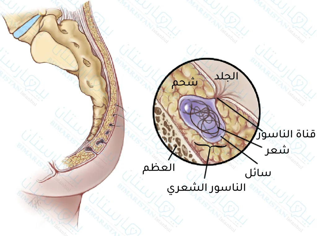 صورة توضح الناسور الشعري العصعصي ومكوناته وفي أي طبقة من الجلد ينشأ غالبا