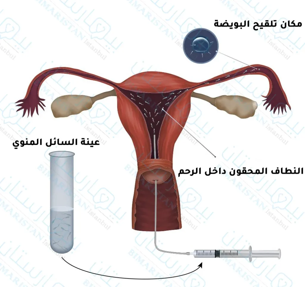 عملية الحقن داخل الرحم والتي تعد من أول الخيارات التي يلجأ إليها الزوجين الذين يعانون من العقم