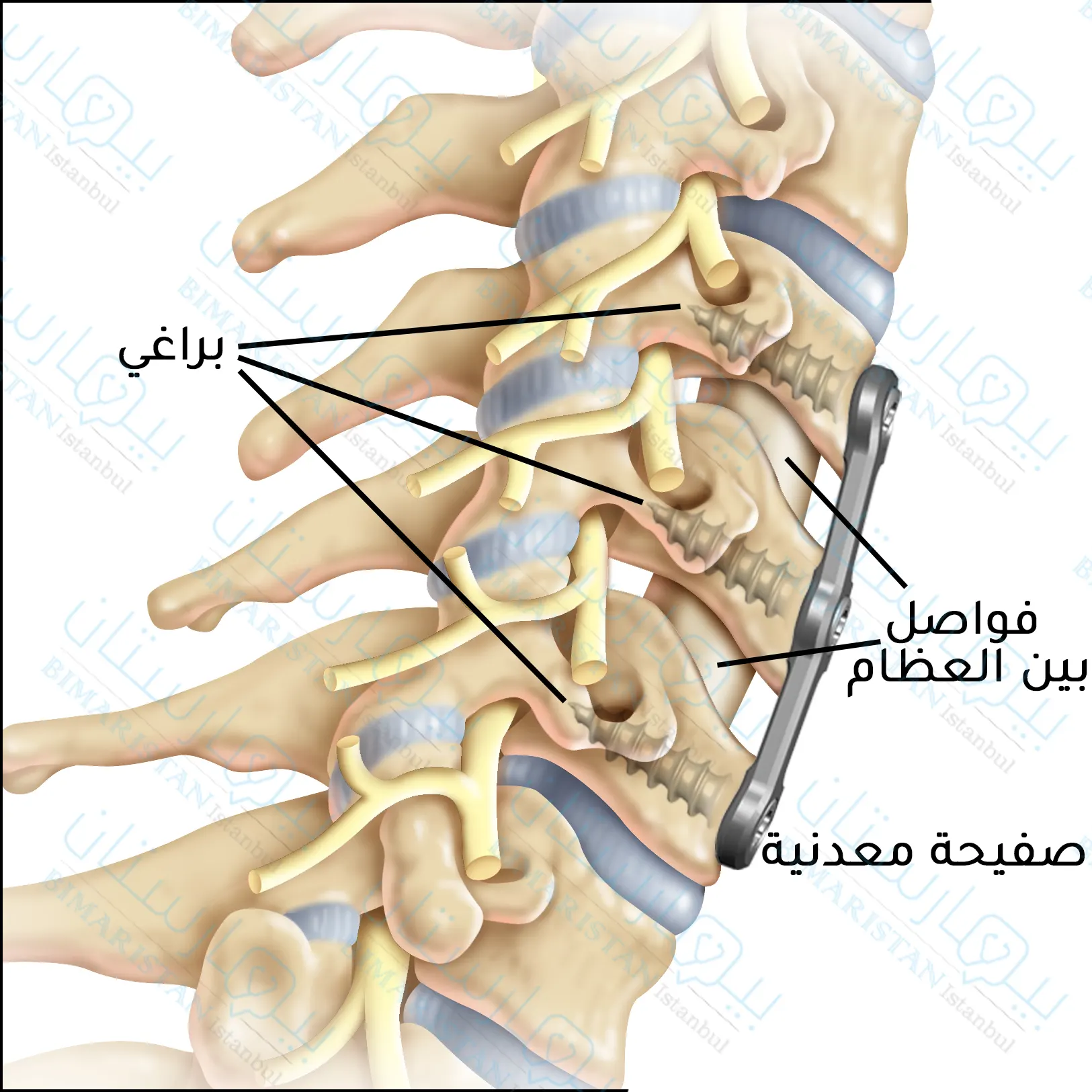 تتم إزالة الأقراص المتأذية ومن ثم دمج الأقراص الفقرية من الأمام بواسطة الصفائح والبراغي