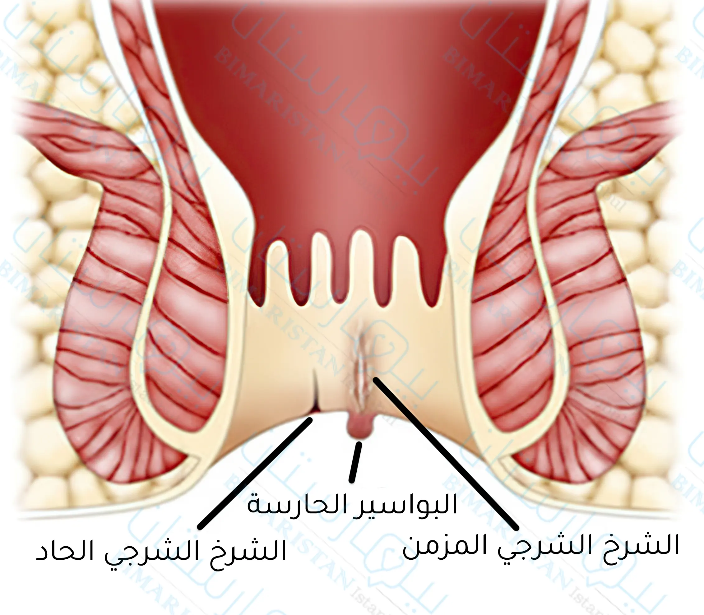 يتميز الشرخ الشرجي المزمن بتشكل علامات الإزمان كظهور النسيج الندبي كما قد يترافق مع البواسير الحارسة