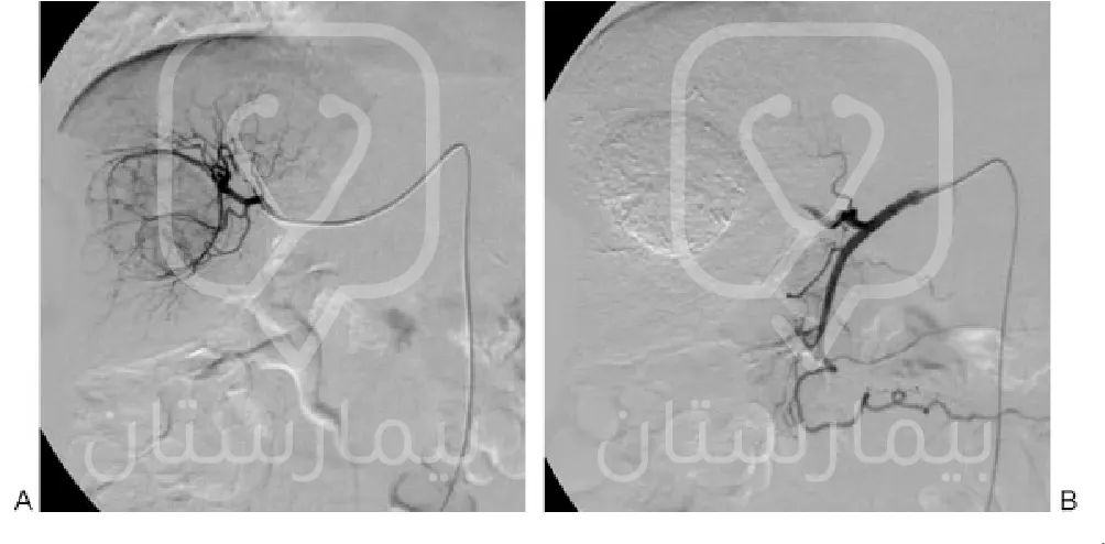 التصوير بالقثطرة لشرايين الكبد قبل وبعد عملية التخثير الكيميائي Chemoembolization