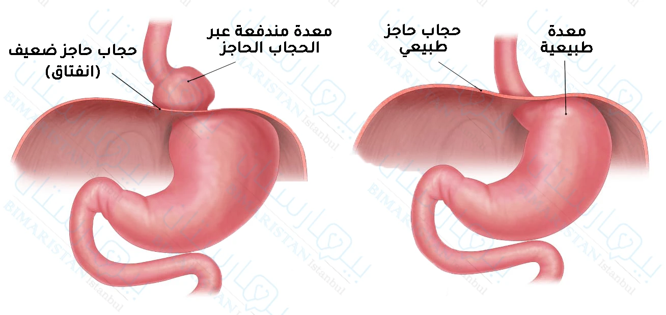 مقارنة بين الحالة الطبيعية وحالة فتق الحجاب الحاجز حيثُ يصعد الحجاب الحاجز المنفتق للأعلى خارج موقعه الطبيعي