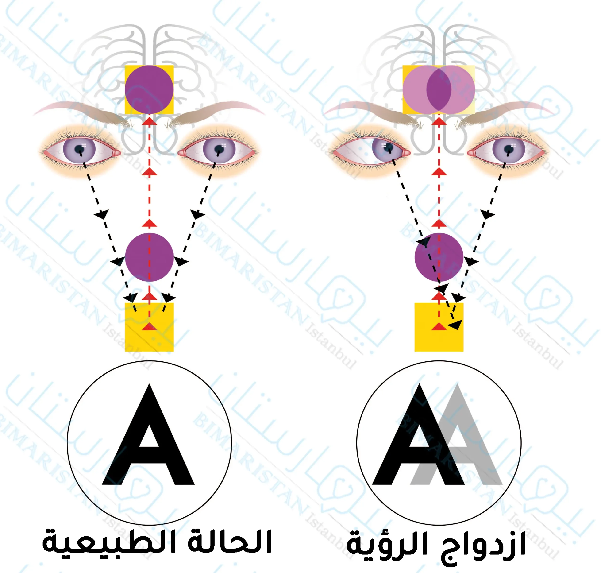 حالة ازدواج الرؤية