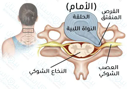 انفتاق القرص الرقبي