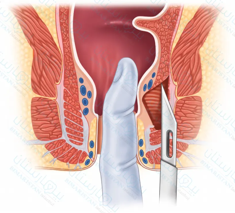 يعتبر الاستئصال الجانبي للمصرة الداخلية الحل النهائي من أجل علاج الشرخ الشرجي المزمن