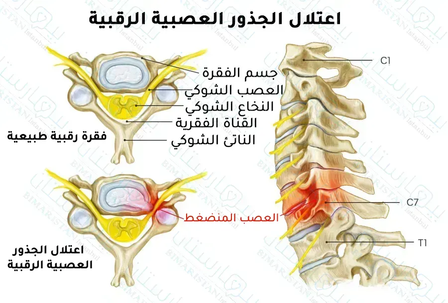 يؤدي انضغاط الأعصاب الرقبية بسبب ديسك الرقبة إلى حدوث اعتلال الجذور العصبية الرقبية