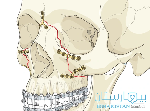 عملية الاختزال المفتوح مع التثبيت الداخلي (Orif) لعلاج كسور الوجه