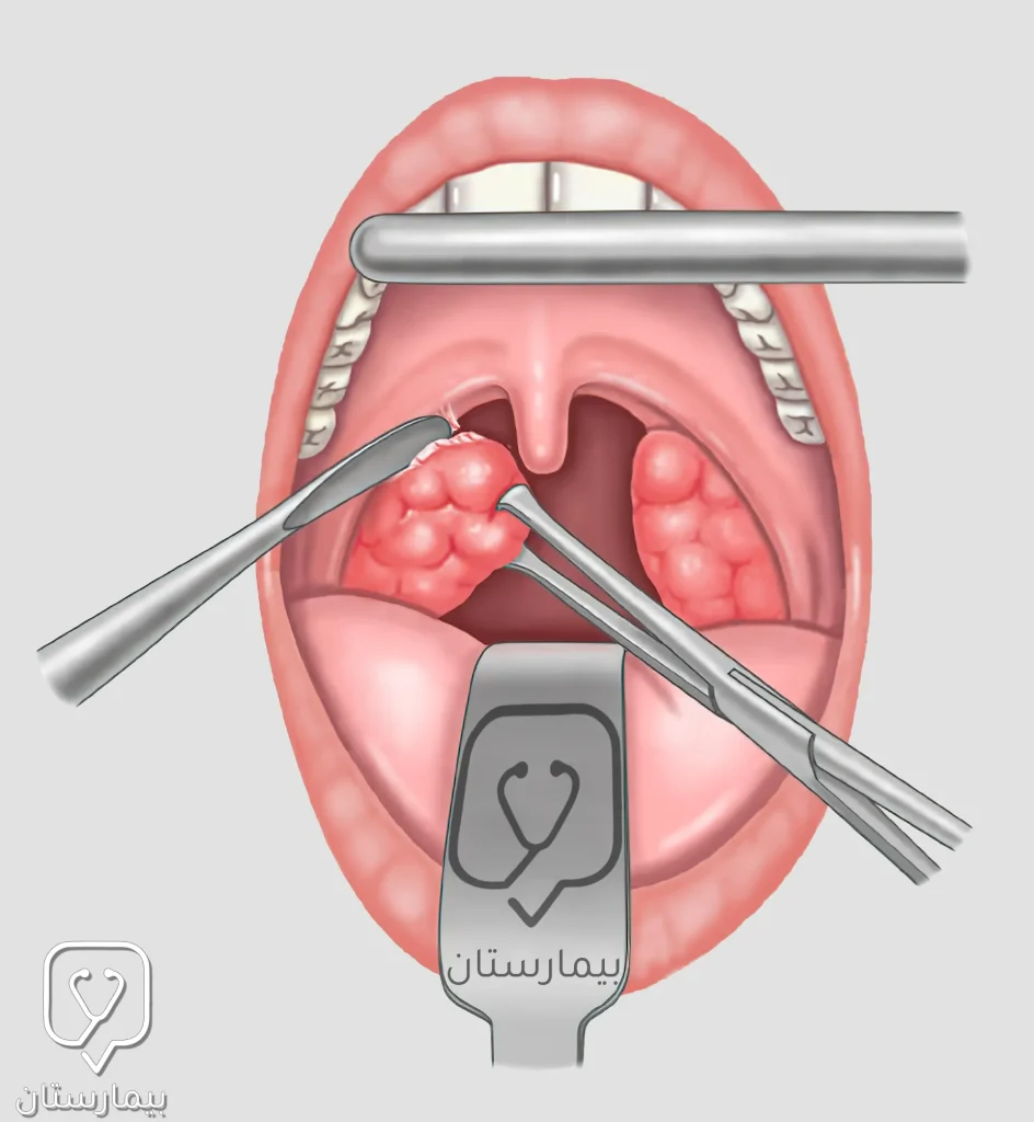 يقوم الجراح في عملية استئصال اللوزتين بتسليخ اللوز المتضخمة عن مجاورتها