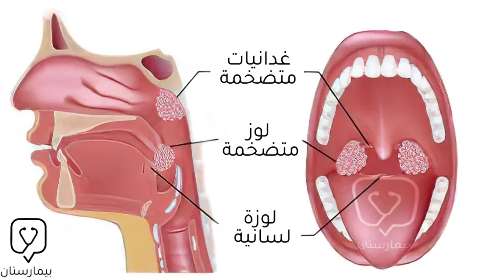 كثيراً ما يترافق تضخم اللوزتين مع تضخم الناميات (الغدانيات)