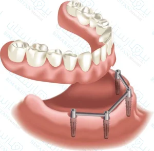 طقم أسنان كامل مدعوم بالزرعات مثبت بقضيب معدني (بار)