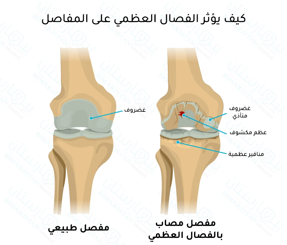 عندما يحدث مرض الفصال العظمي يتأذى الغضروف وينكشف العظم الذي تحته وتظهر مناقير عظمية في العظم المجاور