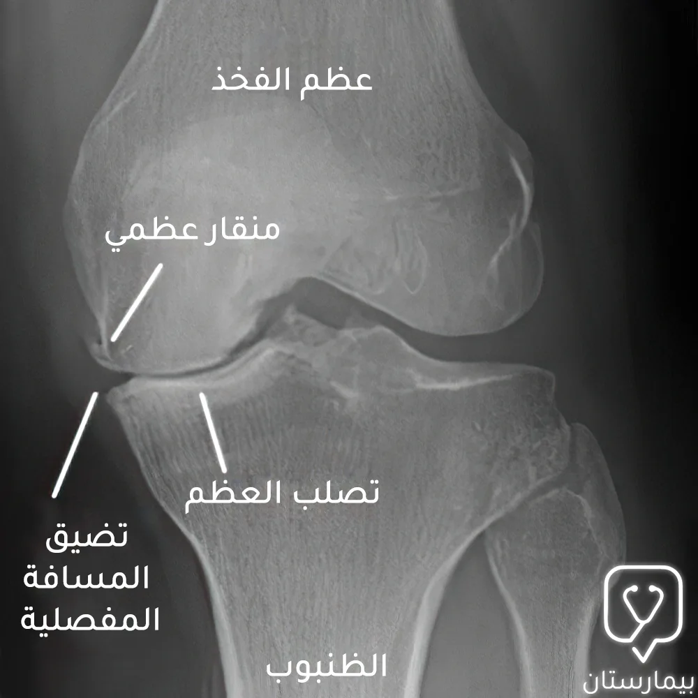 نلاحظ على الصورة الشعاعية تلف في الغضروف المفصلي في الناحية الأنسية لمفصل الركبة وتضيق المسافة المفصلية وتشكل منقار عظمي