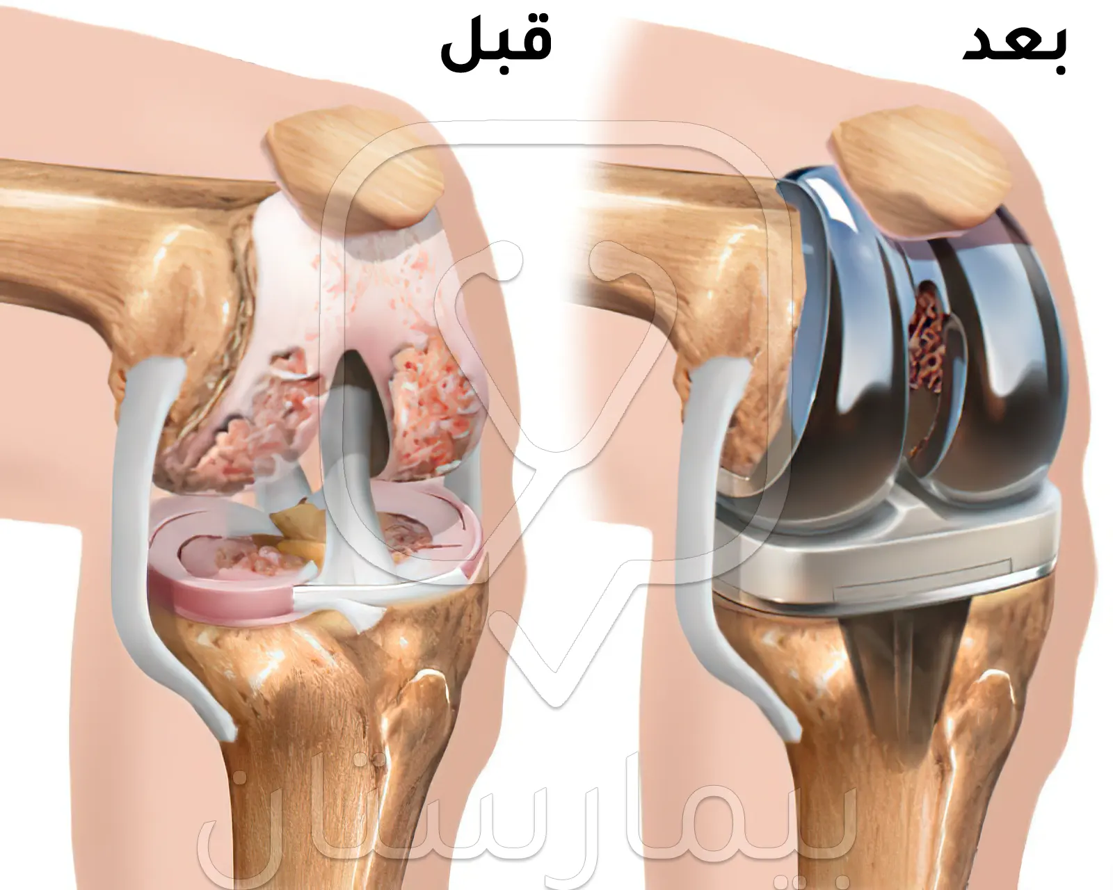 قبل وبعد عملية تغيير مفصل الركبة الصناعي