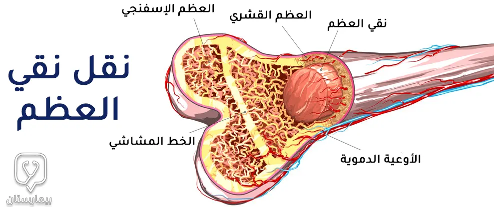 عملية نقل نقي العظم