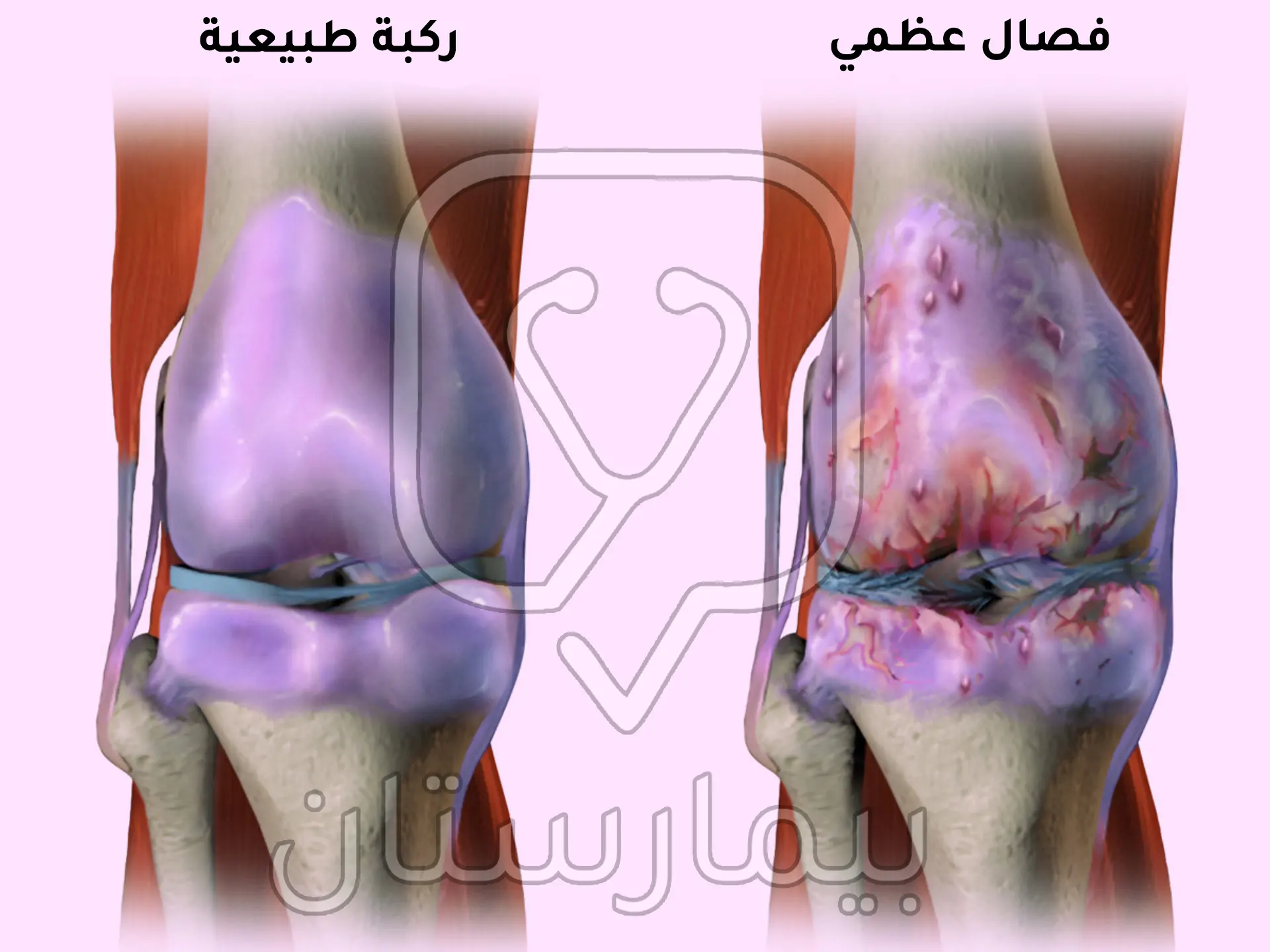 يتميز الفصال العظمي بحدوث تلف مترقٍ في الغضروف المفصلي وتنكس في العظم الواقع تحته