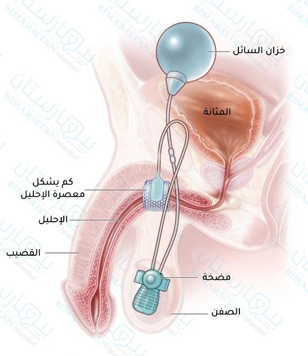 صورة توضح علاج المثانة العصبية جراحياً عبر تركيب معصرة احليل صناعية