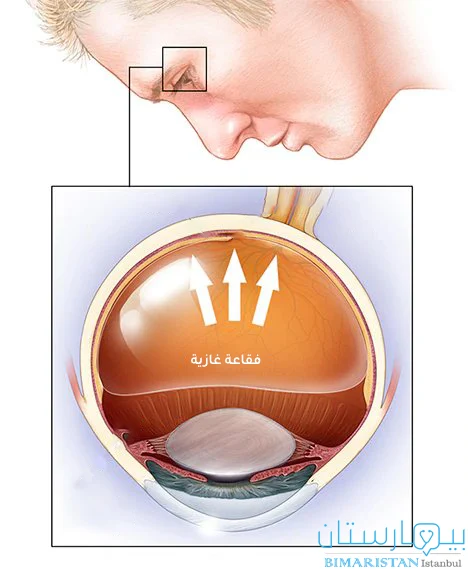 صورة توضح وضعية إبقاء الرأس عند استخدام الغاز في علاج انفصال الشبكية