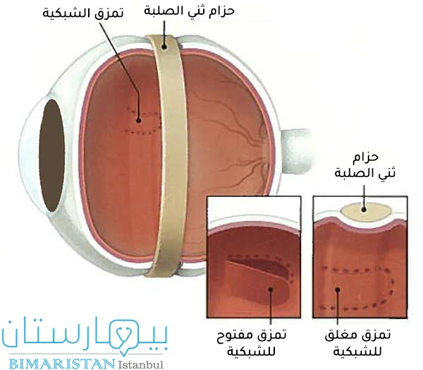 صورة توضح علاج انفصال الشبكية عبر ثني الصلبة