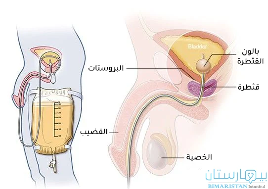 صورة توضح تركيب قثطرة بولية من أجل علاج المثانة العصبية