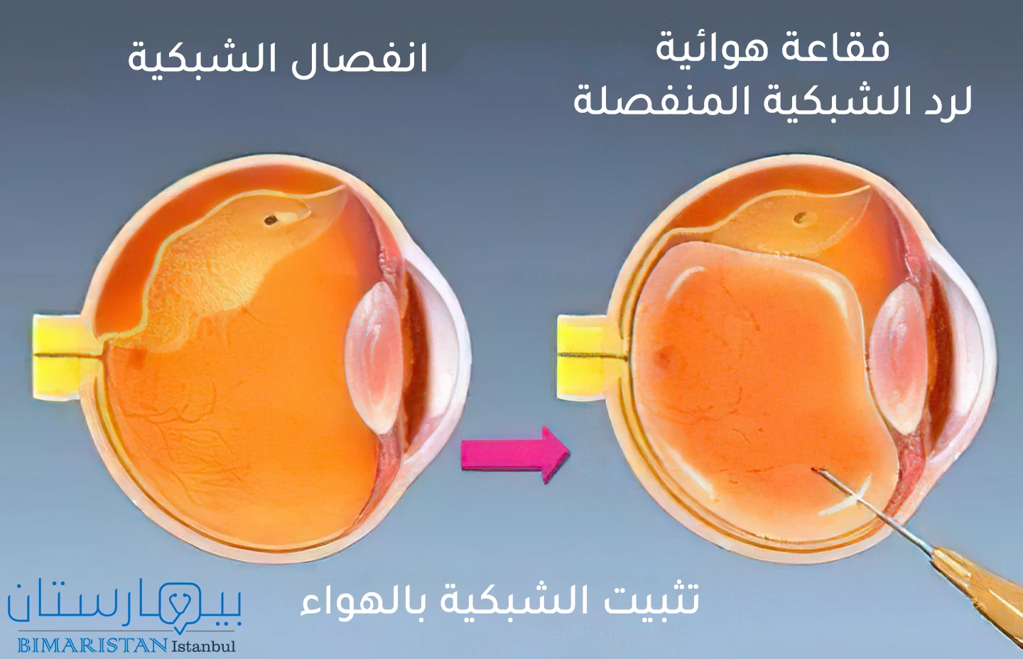 صورة توضح علاج انفصال الشبكية عبر تثبيت الشبكية بالهواء