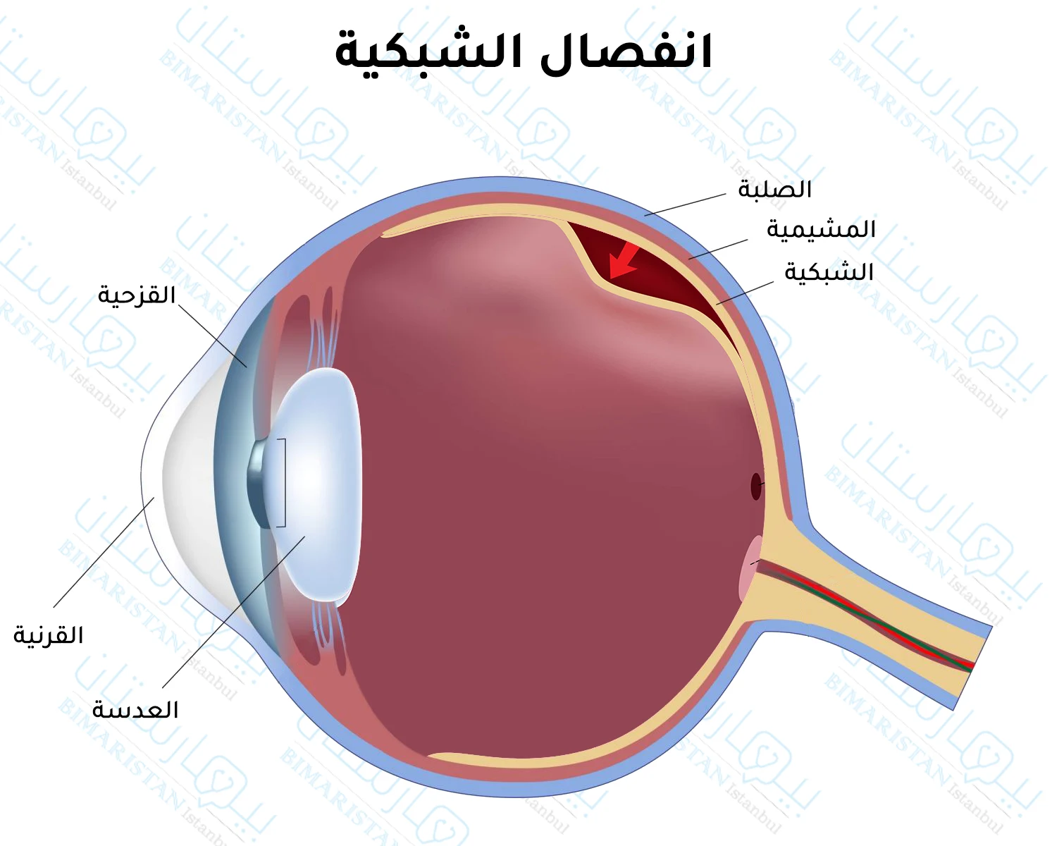 صورة توضح انفصال شبكية العين