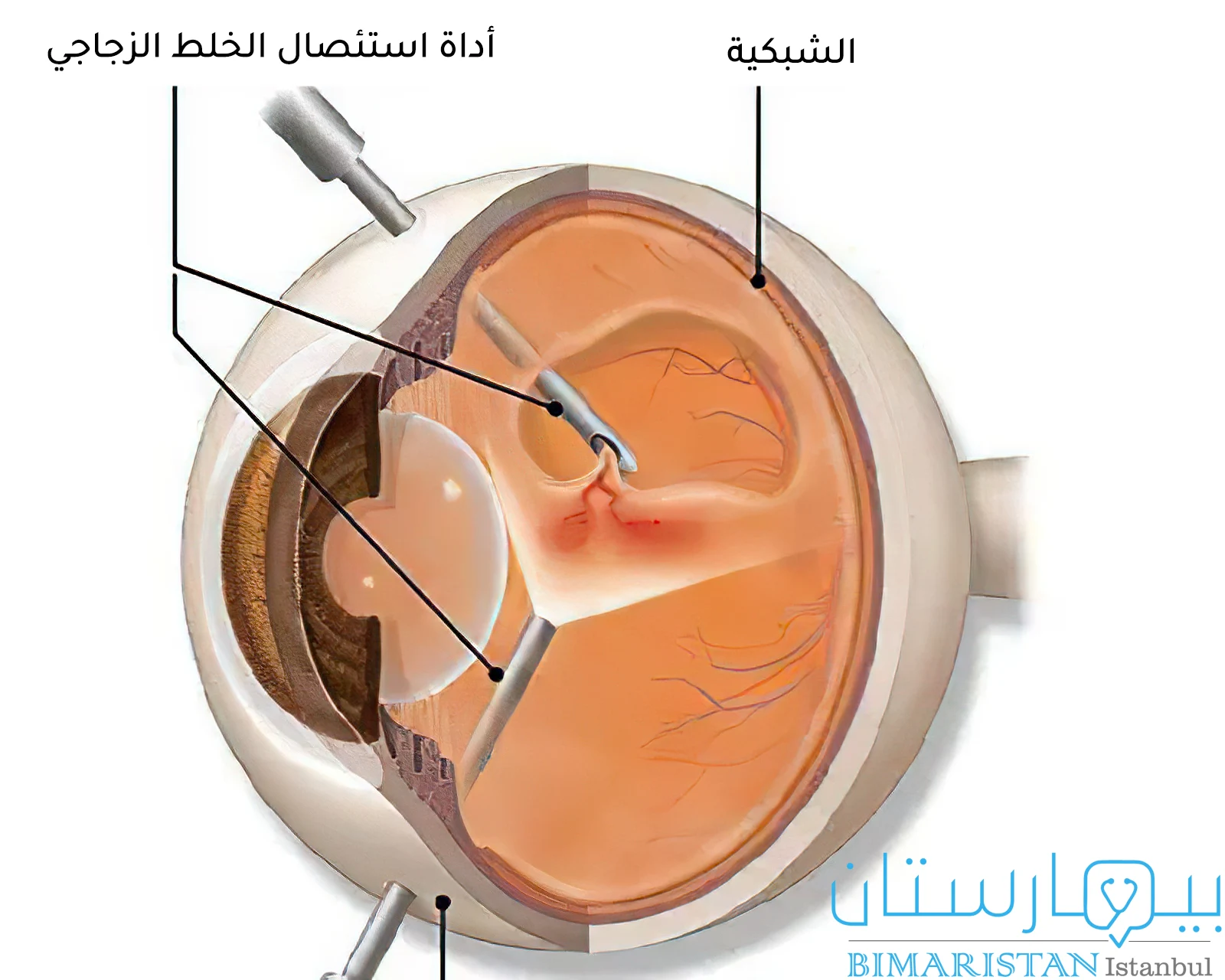 صورة توضح علاج انفصال الشبكية عبر استئصال الخلط الزجاجي