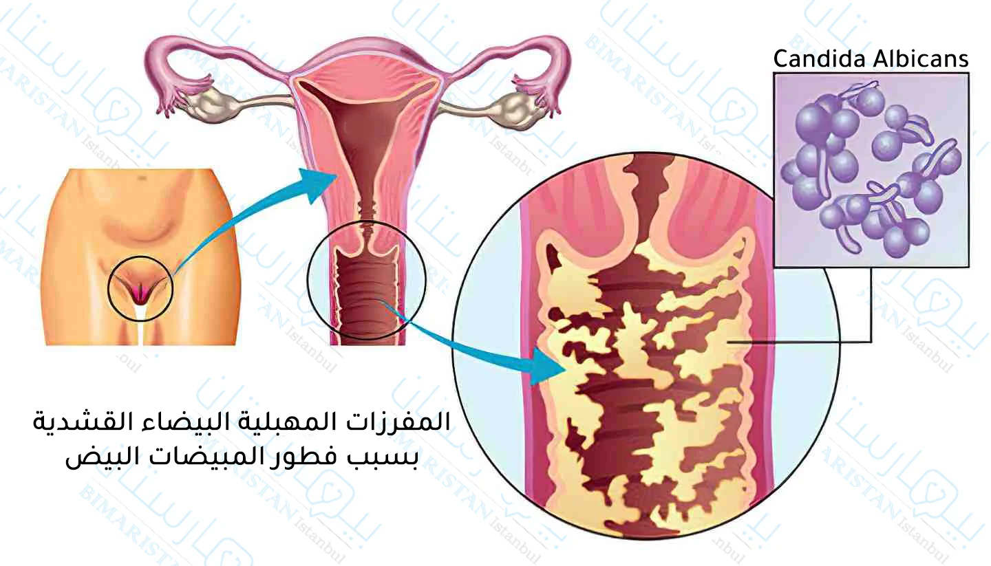 صورة توضح فطور المبيضات لبيض المحدثة لالتهاب المهبل الفطري ونحتاج هنا إلى علاج التهاب المهبل للمتزوجات