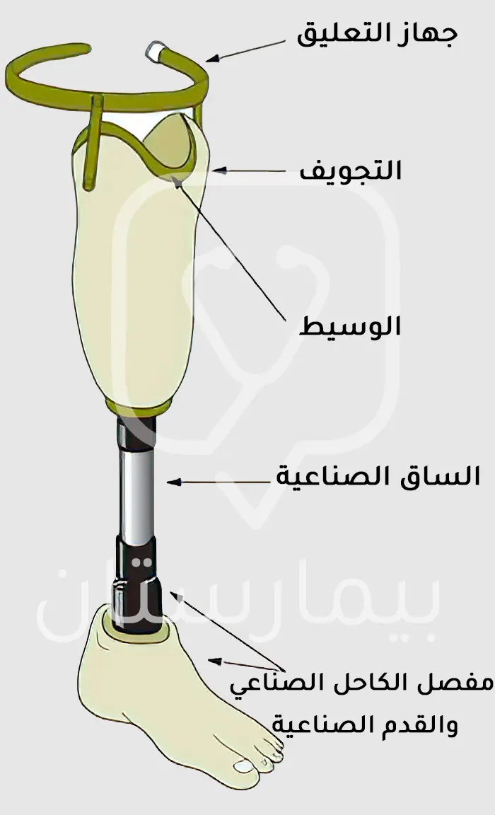 صورة توضح أجزاء الأطراف الصناعية المستخدمة عند تركيب الأطراف الصناعية