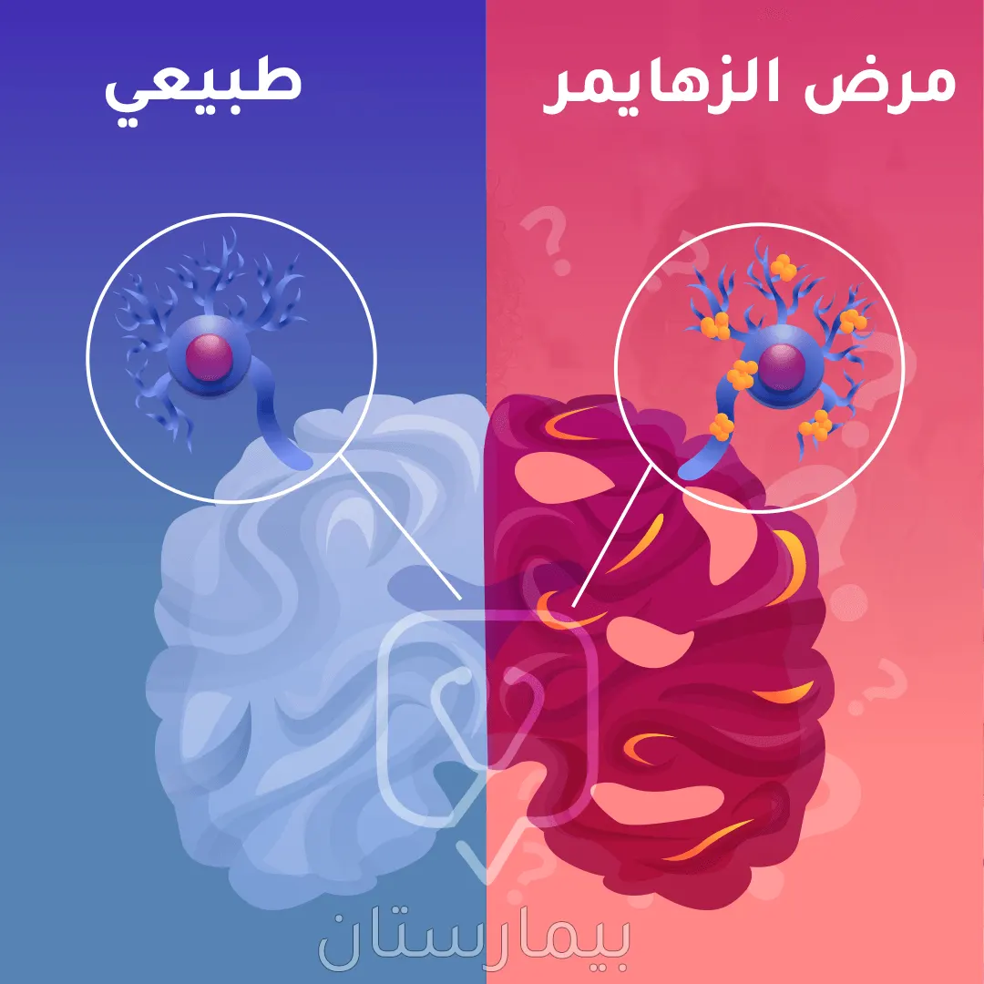 صورة توضح آلية حدوث مرض الزهايمر وتراكم بروتينات الأميلوئيد حول الخلايا العصبية