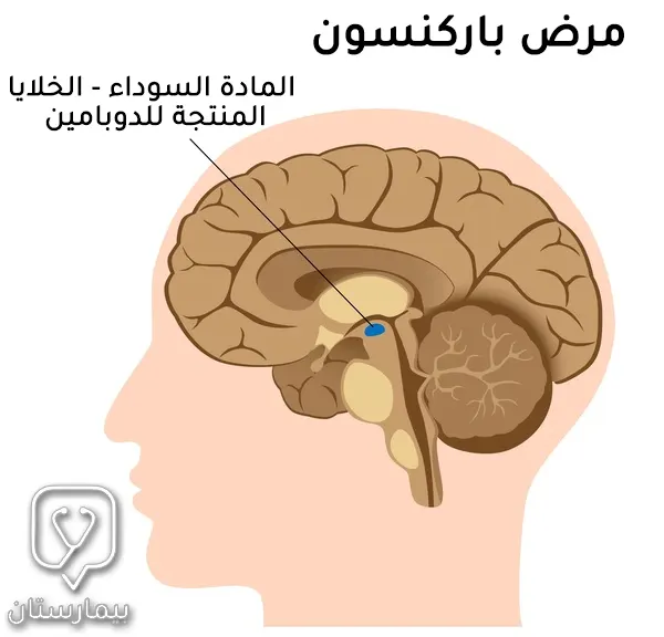 صورة تتحدث عن المادة السوداء التي تصاب في مرض باركنسون (الخلايا المفرزة لمادة الدوبامين)