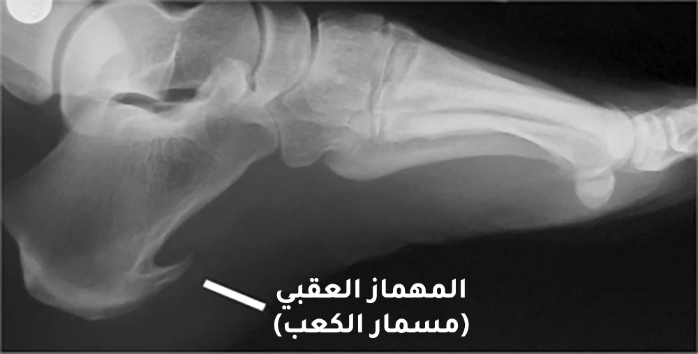 صورة شعاعية توضح مسمار كعب القدم