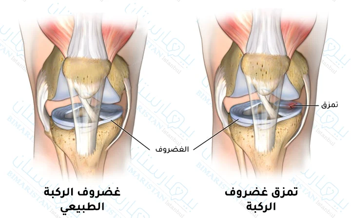 تمزق غضروف الركبة بالصور