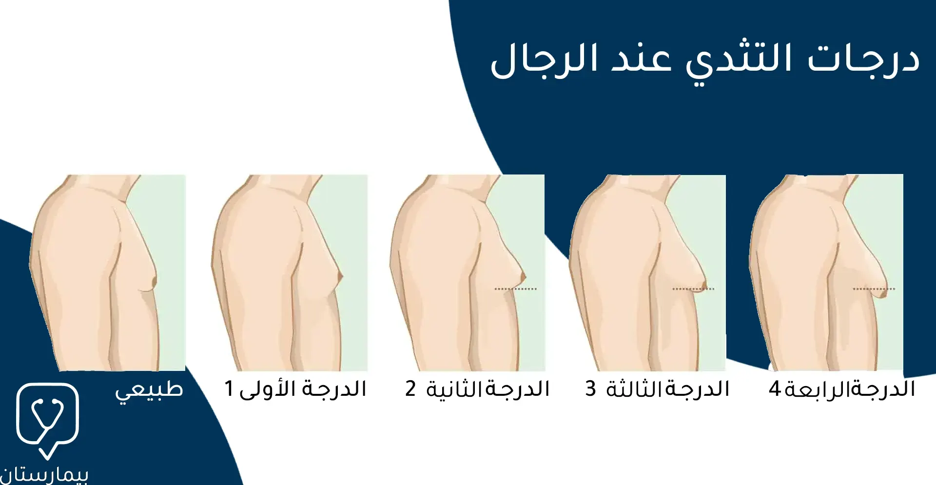 صورة توضح درجات التثدي عند الرجال