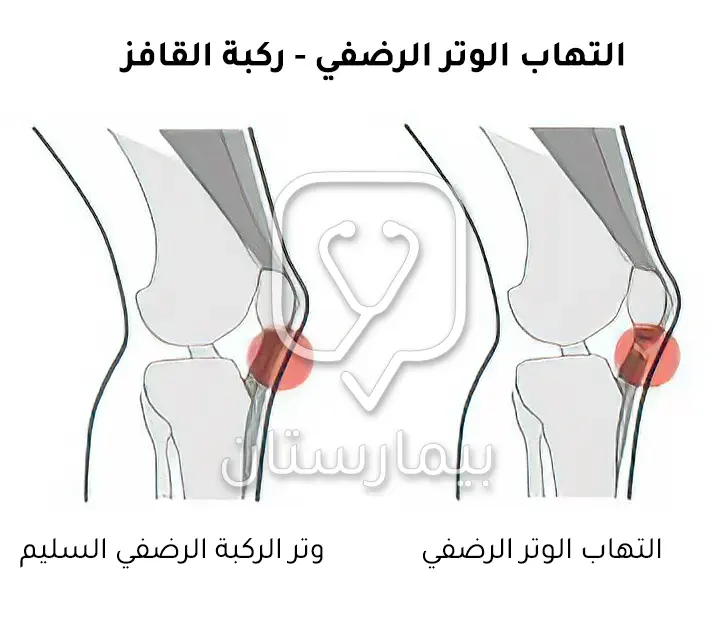 صور توضيحية لالتهاب الوتر الرضفي