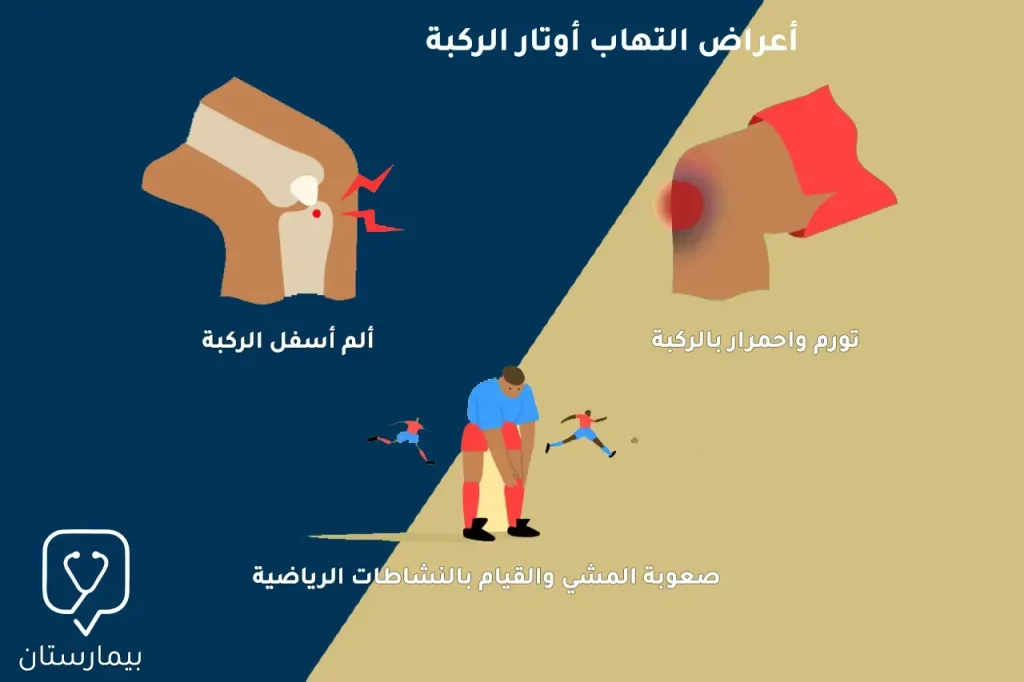 أعراض التهاب أوتار الركبة