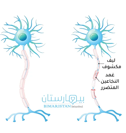 صورة توضح تخرب غمد الألياف العصبية في مرض التصلب اللويحي