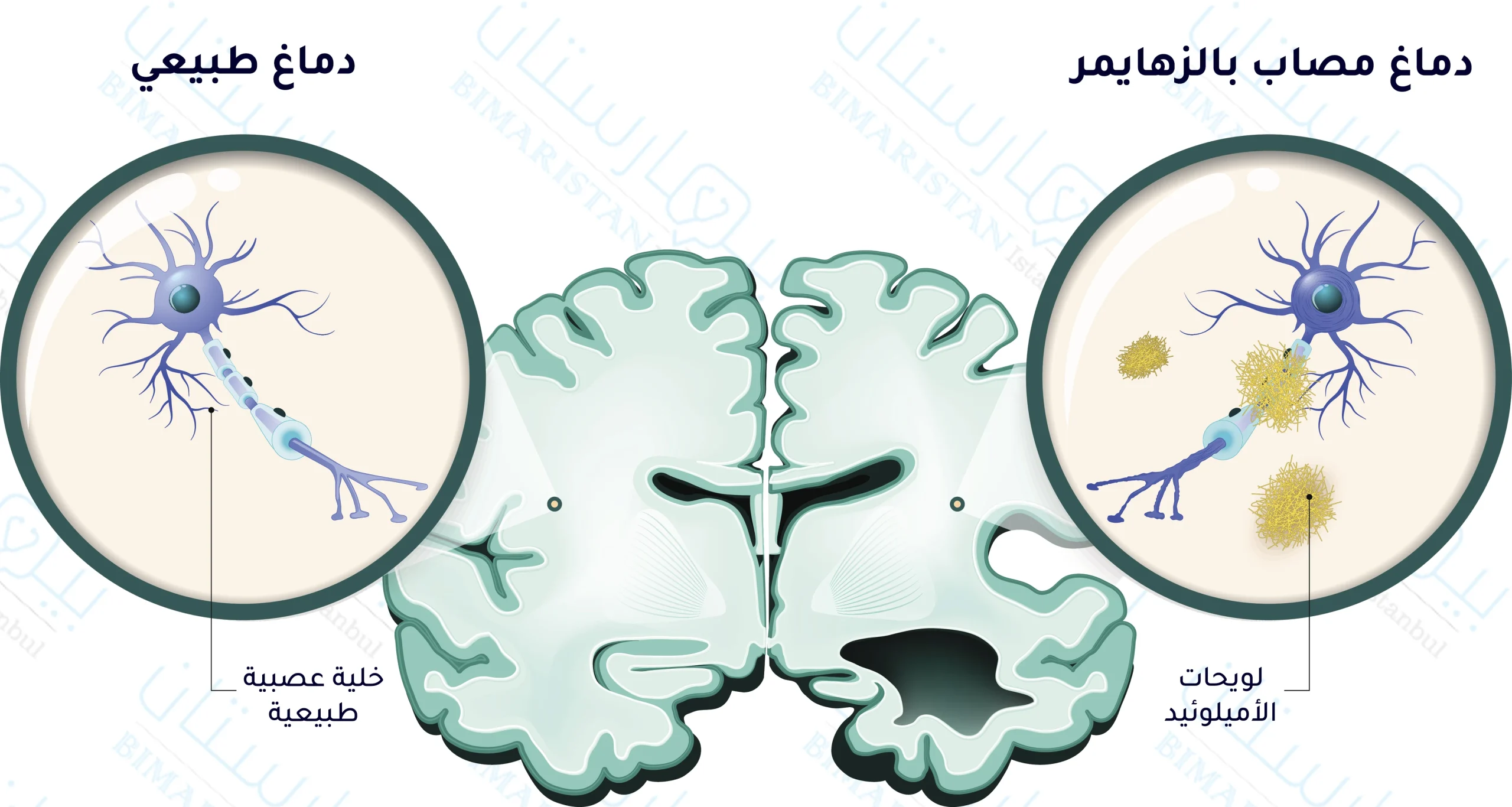 نلاحظ تشكل لويحات الأميلوئيد على الخلايا العصبية وتقلص المادة العصبية في دماغ الشاب المصاب بالزهايمر المبكر