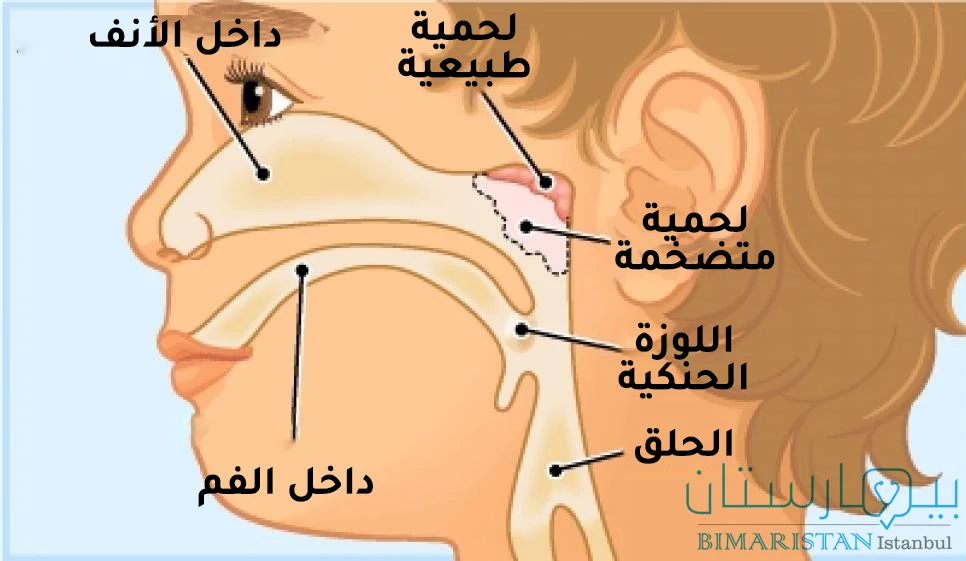 صورة توضح موقع لحمية الأنف وتضخم لحمية الأنف